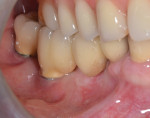 Fig 10. Four-unit fixed dental prosthesis was connected, articulating with the fixed maxillary restoration in an anticipated cross-bite occlusion.