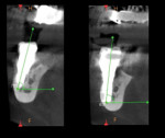 Fig 11. At 5 years post-loading, soft and hard tissues showed great stability. Note that although the implant on the right, site No. 31, is close to the IAN and impinging on the safety zone, there was no consequence to the nerve function.