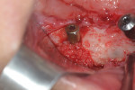 Fig 14. Autogenous bone grafting and a resorbable collagen fleece were used to treat the 1.5 mm buccal dehiscence.