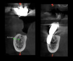 Fig 16. Pre- and post-treatment CBCT analysis. In the pretreatment CBCT (left) there was limited bone above the IAN but sufficient space (5.5 mm) lateral to the nerve. The 3-year post-treatment CBCT (right) showed excellent integration of the implant placed lateral to the IAN with stable peri-implant bone.