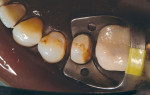Figure 13  A second retainer is used to expose the margins of this seven-eighths crown preparation.