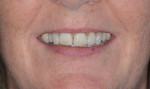 Fig 2. Pretreatment close-up full smile showing the patient’s wide central incisors, uneven color, and PFM crowns.