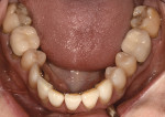 Fig 6. Pretreatment mandibular occlusal view showing previously restored teeth.