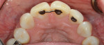Fig 7. Pretreatment close-up occlusal view of maxillary anterior teeth demonstrating attrition.