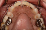 Fig 9. Intraoral view of the Kois deprogrammer for a single point of contact.