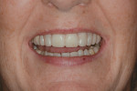Fig 10. Mock-up try-in allowing patient to preview her new smile prior to tooth preparation.