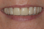 Fig 11. Patient-approved provisional restorations.