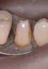 Figure 17  Details of the maxillary prosthesis finished after the reconstruction of the canines.