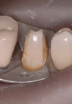 Figure 14  Close-up of the retainer used to isolate the tooth for crown preparation.