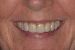 Fig 13. Post-treatment close-up smile; note that the smile is now more balanced and harmonious than before treatment.