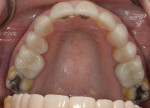 Fig 14. Post-treatment maxillary occlusal view showing final restorations.