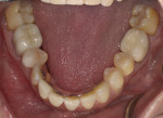 Fig 15. Post-treatment mandibular occlusal view showing final restorations.