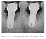 Pre- (left) and post-treatment (right) with alloOss® Plus