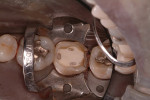 Figure 15  A second retainer is used backwards to assist in the preparation of a cast-gold onlay.