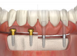 Fixed full-arch options: LOCATOR FIXED™
(left); screw-retained (right)