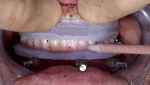 Fig 7. Luting agent was injected into the facial luting holes on the provisional, which was secured with the patient closed into maxillary mandibular relations.