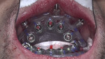 Fig 9. To recover the original treatment plan, a third pick-up was undertaken by securing the BFG, placing Ti-copings on three anterior mandibular implants, and securing the implant surgical guide over them.