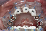 Fig 12. Keratinized gingival tissue was displaced buccally and inferior to the No. 19 site to ensure at least 3 mm of keratinized gingiva remained on the buccal aspect.