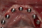 Fig 13. A healing abutment was placed on the No. 19 implant, and suture caps were placed on the other healed implants.