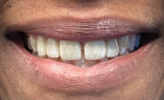 Fig 8. The patient’s smile at 6-month hygiene recall appointment. The patient had completed a 4-month clear aligner treatment and received a bridge and crowns.