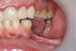 Fig 1. Initial clinical situation, left mandible. Note severe vertical and horizontal defect with two failing implants.