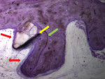 Fig 7. Histology No. 1 (magnification 20 x 0.5). The following observations were made: (1) Perfectly osseointegrated biomaterial particles with new bone tissue in apposition were present. (2) Osteoid tissue was present on the surface of the particle and on the adjacent bone (red arrows) in a process of bone formation by apposition, surrounded by dense and highly vascular connective tissue. (3) Osteoid tissue was apposed by lines of cubic cells with a typical osteoblast profile, light blue coloration, making the osteoids easy to identify. (4) Reversion lines were present (green arrow), corresponding to zones of mature bone tissue apposition, after the process of the primary bone matrix remodeling. (5) The biomaterial’s remodeling interface integrated in the surrounding bone (yellow arrow).