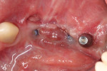 Fig 9. Clinical situation 14 months after GBR and 3 months after implant placement.