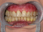 Fig 1 through Fig 3. At presentation in May 2006: patient’s oral condition, frontal view (Fig 1); maxillary arch, occlusal view (Fig 2); mandibular arch, occlusal view (Fig 3).