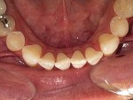 Fig 9. Initial condition of mandibular arch, occlusal view.