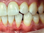 Fig 10. Initial condition showing poor interproximal spacing, especially distal of tooth No. 23.