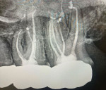 Posttreatment image of both teeth following the GentleWave procedure. The crowns were planned for replacement.