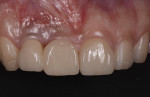 Fig 1. Initial presentation; dark discoloration and a black triangle were present 1 year after implant reconstruction.