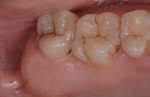 Fig 3. Donor site: maxillary left tuberosity and interdental tissue area.