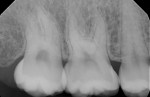 Fig 4. Periapical radiograph showing no periodontal bone loss around the maxillary right first and second molars, no periapical lesion, and no subgingival calculus. Probing depths for both molars were 5 mm and 6 mm due to an excess of soft tissue.