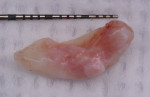 Fig 6. Harvested tuberosity graft (6 mm x 15 mm); connective tissue side.