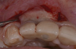Fig 10. Occlusal view; two vertical incisions and tension-free mobilization of the flap.