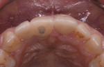 Fig 18 and Fig 19. Occlusal view of anterior restoration area prior to surgery (Fig 18) and at 1-year follow-up (Fig 19).