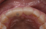 Fig 18 and Fig 19. Occlusal view of anterior restoration area prior to surgery (Fig 18) and at 1-year follow-up (Fig 19).