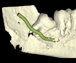 Fig 2. 3D reformation, with IAN represented, lingual plate digitally removed, tooth No. 17, lingual view. Note close proximity of the IAN to the apical aspect of the tooth roots lingually.
