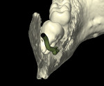 Fig 3. 3D reformation, with IAN represented, lingual plate digitally removed, tooth No. 17, posterior-to-anterior view. Note IAN position related to the apical third of the tooth roots.