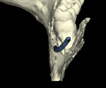Fig 6. 3D reformation, with IAN represented, lingual plate digitally removed, tooth No. 32, posterior-to-anterior view. Note IAN position related to the apical third of the tooth roots.