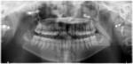 Fig 8. Case 1. Postoperative panoramic radiograph, removal of teeth Nos. 1 and 16, coronectomies on teeth Nos. 17 and 32.