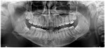 Fig 9. Case 2. Preoperative panoramic radiograph for removal of third molars. Note the proximity of the IAN canal and darkening of the apical third of the roots of teeth Nos. 17 and 32, and radiographic inferior displacement of the IAN canal associated with tooth No. 32.