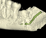 Fig 10. 3D reformation, with IAN represented, lingual plate digitally removed, tooth No. 32, posterior-to-anterior view. Note intimate proximity of the apices of tooth No. 32 to the IAN and the mesiobuccal root tip surrounding the IAN.