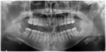 Fig 12. Case 2. Postoperative panoramic radiograph, removal of teeth Nos. 1 and 16, coronectomies on teeth Nos. 17 and 32.