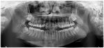 Fig 13. Case 3. Preoperative panoramic radiograph for removal of third molars. Note the proximity of the IAN canal and darkening of the apical third of the roots of teeth Nos. 17 and 32, and radiographic inferior displacement of IAN canal associated with tooth No. 32.