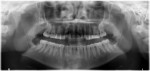 Fig 16. Case 3. Postoperative panoramic radiograph, removal of teeth Nos. 1 and 16, coronectomies on teeth Nos. 17 and 32.