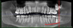Fig 17. Case 4. Preoperative panoramic radiograph. Note full bony
impacted tooth No. 16, horizontal impacted supernumerary teeth Nos.
66, 67 and tooth No. 17, bone loss distal to tooth No. 18, proximity of
the IAN canal to tooth No. 17, and darkening of the apical third of the
roots of tooth No. 17.