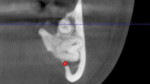 Fig 19. Crosssectional view, IAN represented, teeth Nos. 17 and 67 in cross section, apical region of the roots. Note IAN appears to be compressed by the root of tooth No. 17. Thinning of the mandibular lingual plate is present.