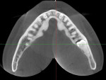 Fig 21. Axial view, tooth No. 17. Note position of the tooth within the mandibular ramus with thinning of the mandibular lingual plate.